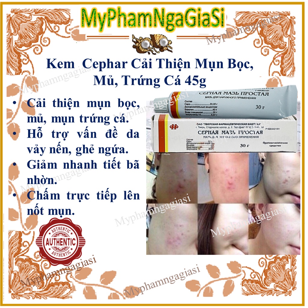 Kem Mụn Lưu Huỳnh Cephar. Mụn bọc, trứng cá, ghẻ ,vảy nén