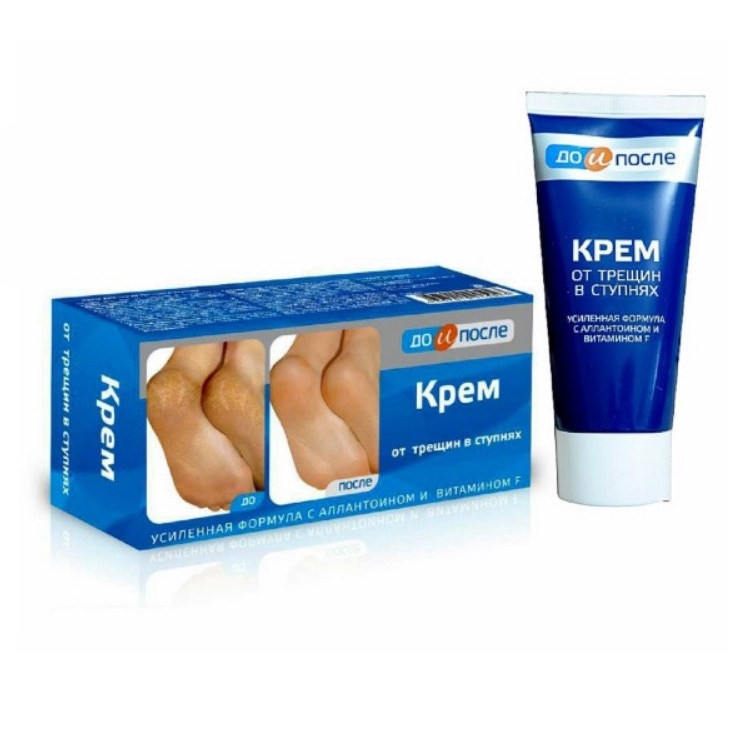 kem nẻ gót chân Kpem Foot Cream giảm nẻ chân nứt chân khô da chân dưỡng gót chân cam kết h.quả sau ít nhất 1 liệu trình