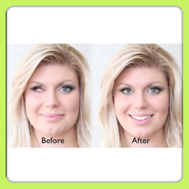 Lens thẩm mỹ kính áp tròng cho mắt hỏng