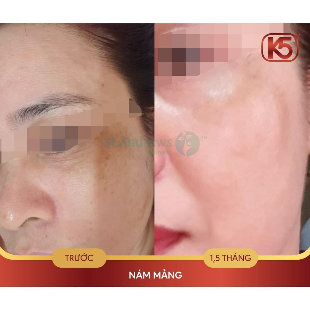 Kem mờ nám tàn nhang K5 Lipogel 40ml, hiệu quả đã được chứng minh