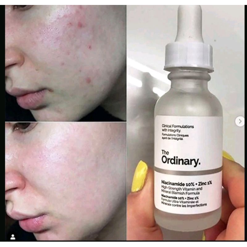 Tinh chất giảm mụn serum niacinamide 10% the ordinary