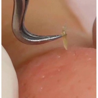 [Ảnh Thật – Clip thật] Bộ Dụng Cụ Nặn Mụn 5 Chi Tiết ( Cao Cấp )