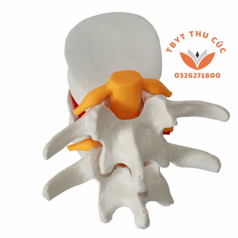 Mô hình thoát vị cột sống