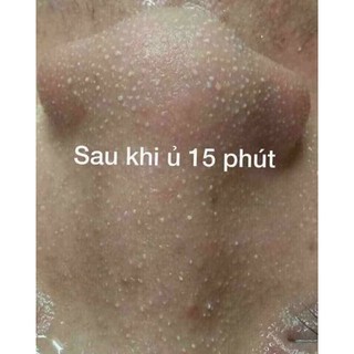 Ủ mụn đầu đen, mụn cám YOUNGER