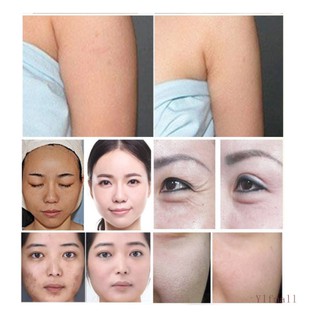 Máy Nâng Cơ Trẻ Hóa Da Hifu V-MAX