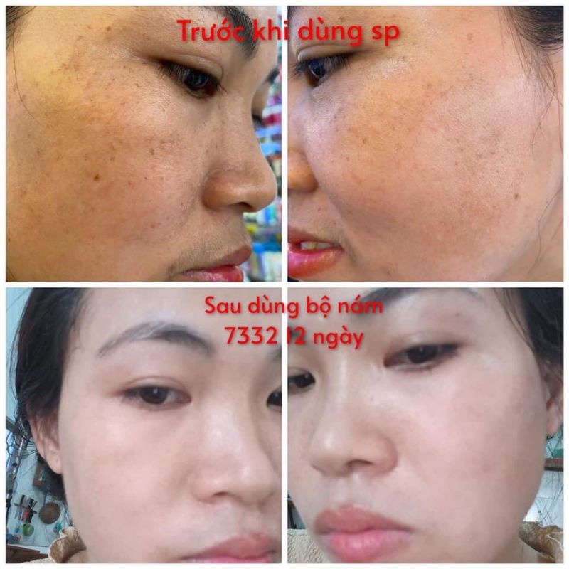 Serum Sáng Da Ngừa Nám DORO 30ml – Sáng Da, Ức Chế Sắc Tố, Ngừa Nám Sạm và Dưỡng Da Khỏe