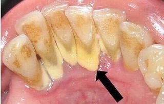 BỘT LÀM TRẮNG RĂNG THẢO DƯỢC DẠ THẢO LIÊN