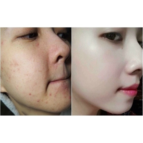 Bộ 2 sản phẩm loại mụn, làm sạch da Acosmetics: Kem loại bỏ mụn siêu tốc và Sữa rửa mặt trà xanh 120ml