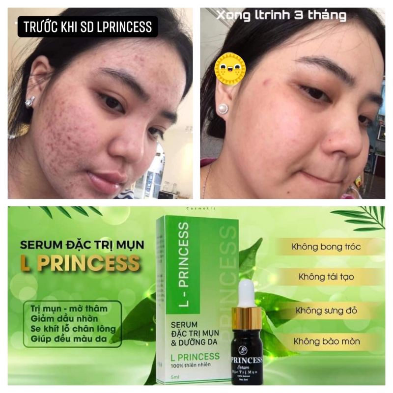serum mụn L PRINCESS vua diệt mụn Chính Hãng