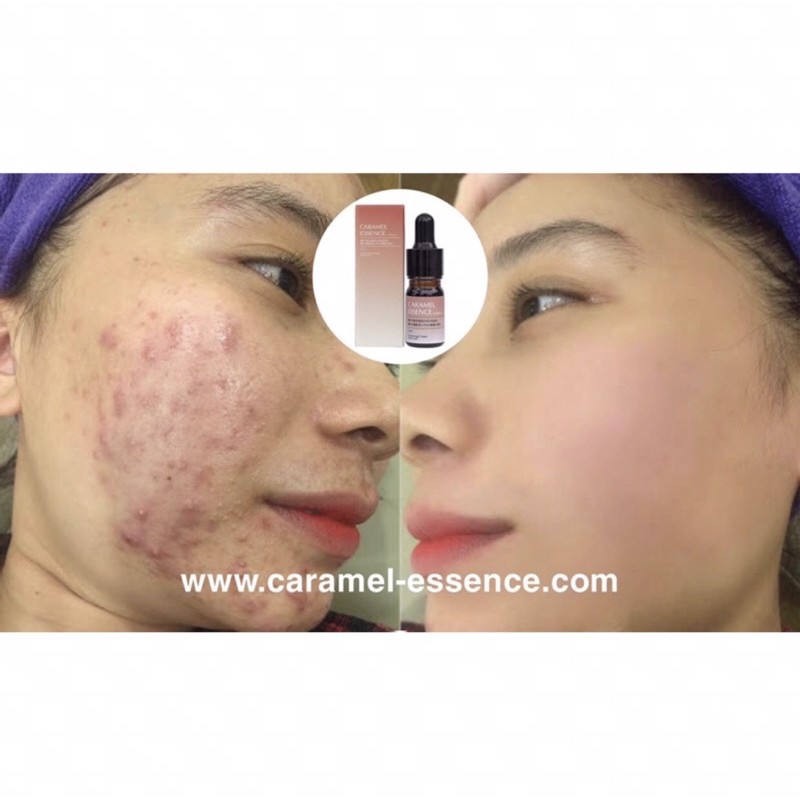 Serum giảm mụn thâm caramel essence Nhật Bản