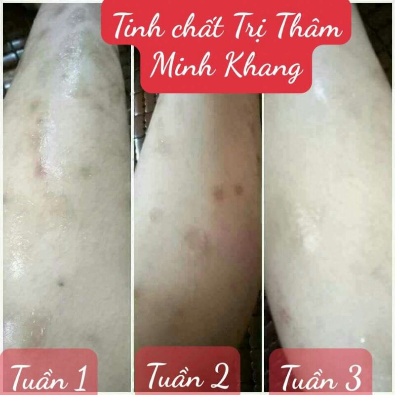 Tinh chất mờ thâm Minh Khang tặng quà hấp dẫn | BigBuy360 - bigbuy360.vn