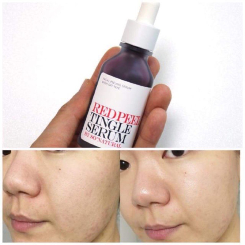 Tẩy Da Chết Hoá Học Red Peel Tingle Serum