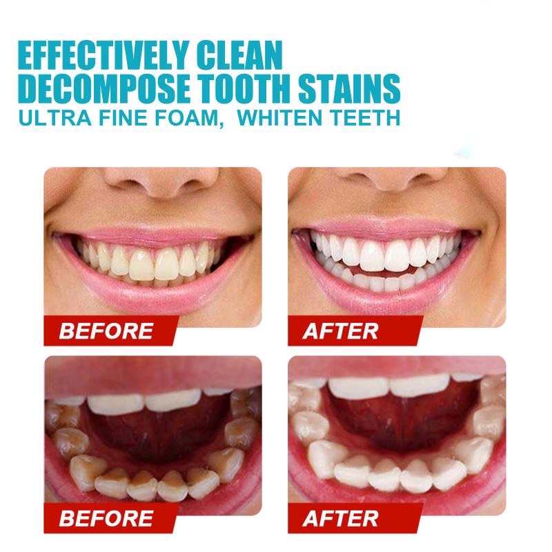 WhiteFoam Leblanc làm sạch máng chỉnh nha trong suốt như Invisalign