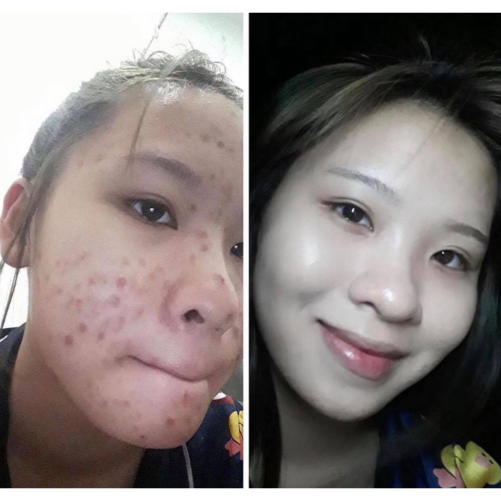 Serum Thảo Dược Khang Luxury xóa bay sẹo làm mờ thâm sẹo rỗ giúp da mịn màng khít lỗ chân lông 50ml - TDK SKIN