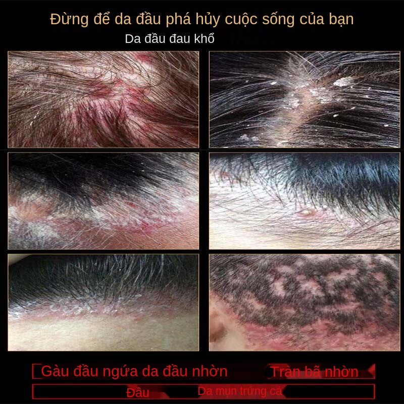 dầu gội đầu Scalp folliculitis shampoo anti-dandruff/antipruritic/mite removal/oil control men and women anti-dandruf