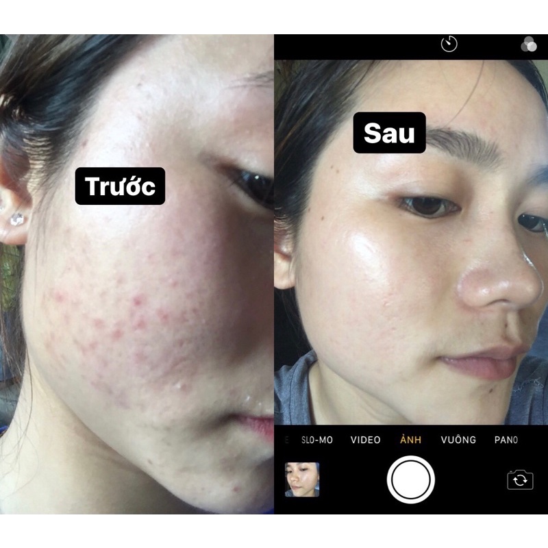 KEM MỤN X2 TH BEAUTY