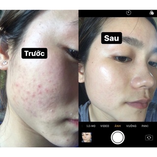 KEM MỤN X2 TH BEAUTY