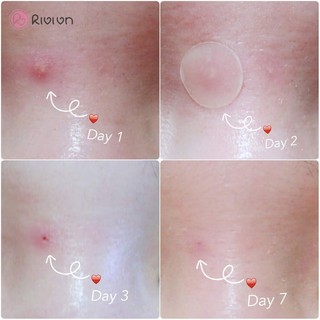 MIẾNG DÁN MỤN COSRX ACNE PIMPLE MASTER PATCH