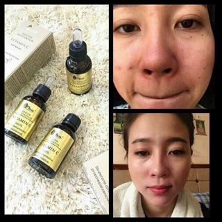 Serum Vitamin C