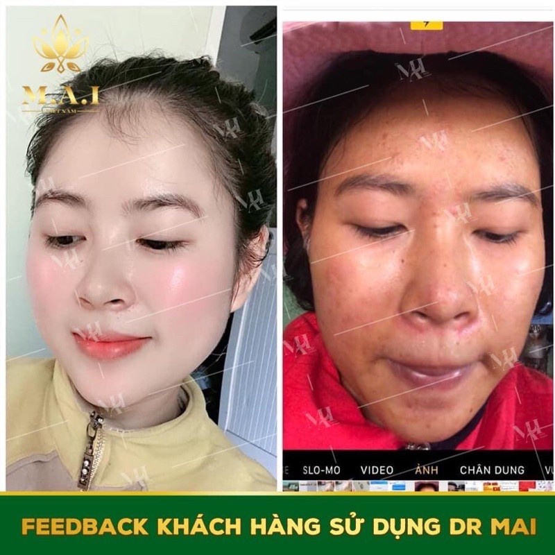 Dr Mai, Mụn Dr Mai, thảo dược ngăn ngừa lựa chọn hoàn hảo cho da mụn