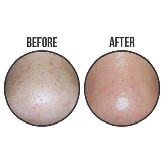 ( CHÍNH HÃNG ) MIẾNG DÁN ĐẨY MỤN ĐẦU ĐEN GOODBYE BLACKHEAD CIRACEL