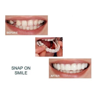 Veneers silicon mềm tạm thời giả trên