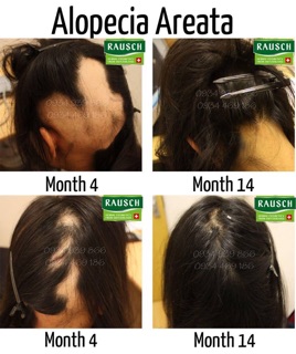 Tinh Dầu Trị Hói Rausch Từ Thuỵ Sĩ