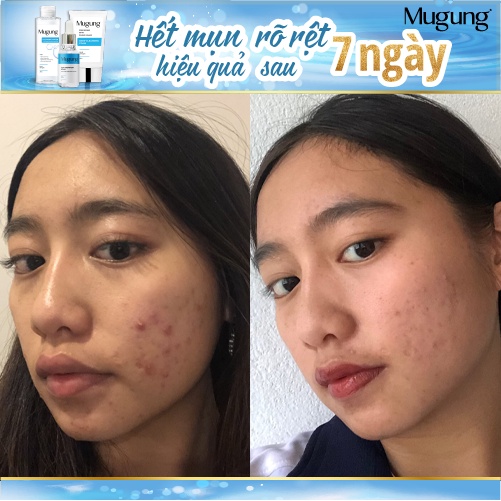 Serum giảm mụn Mugung 7 ngày hiệu quả giảm mụn đầu đen,mụn bọc (Làm xẹp không bong da) Acne Treatment 15ml