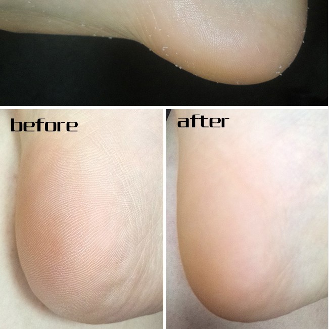 Chai xịt FOOTMEDI chăm sóc da chân tẩy tế bào chết hiệu quả dung tích 100ml