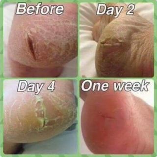 KEM TRỊ NỨT GÓT CHÂN
