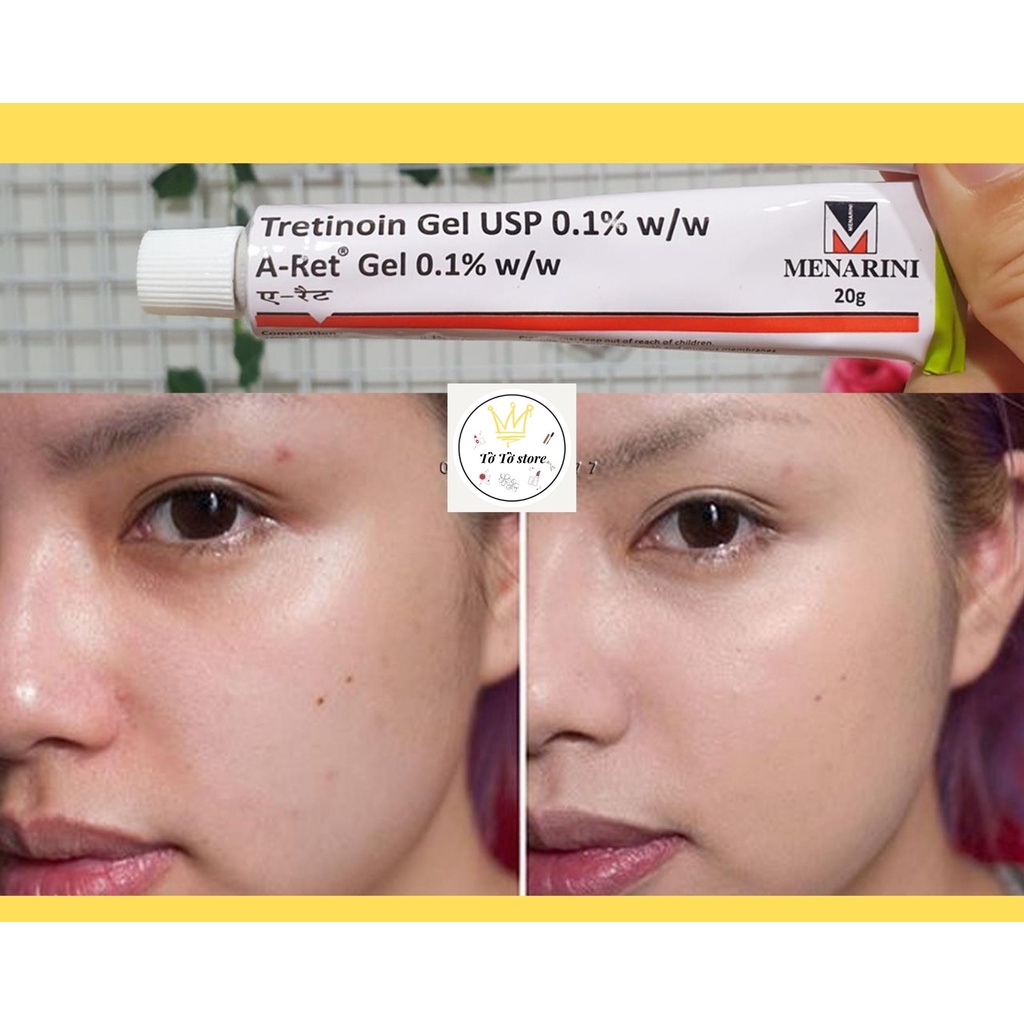 Tretinoin Aret 0.1%, 0.05%, 0.025%, Gel hỗ trợ giảm mụn [CÓ ẢNH THẬT]