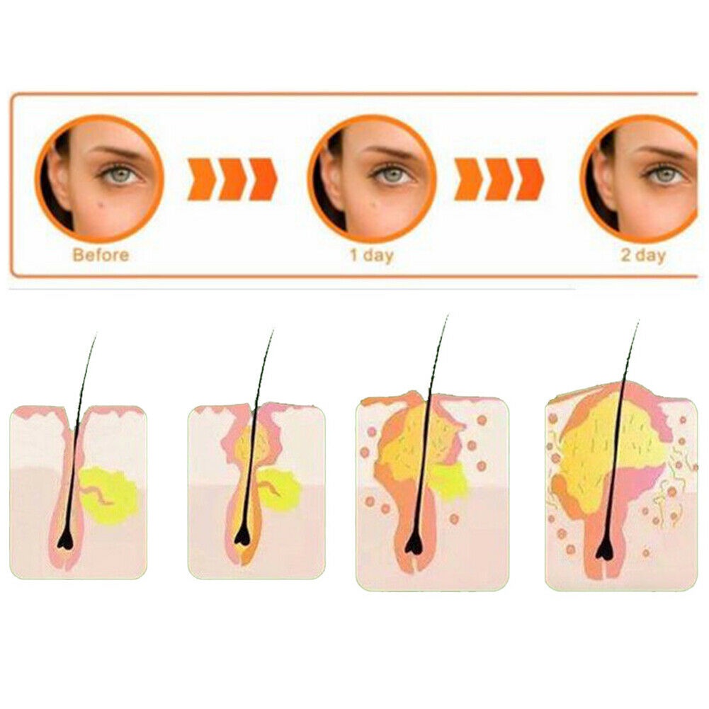 ♕38 Miếng Dán/1 Túi Miếng Dán Mụn Trứng Cá Miếng Dán Mụn Trứng Cá Vô Hình Thoáng Khí Miếng Dán Điều Trị Mụn Lành Vết Thâm Chống Thấm Nước Nhãn Dán Chăm Sóc Da Mặt UPBEST