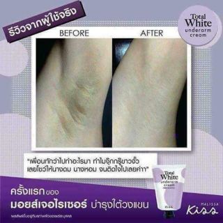 Kem trị thâm nách Kiss Total white