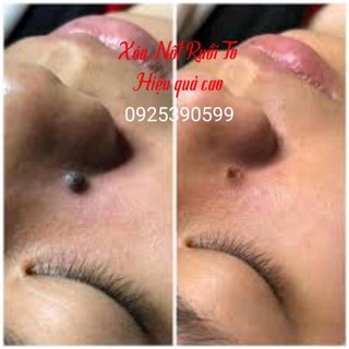 Tẩy Mụn Cóc Nốt Ruồi Tàn Nhang Mắc Cá ,Mụn Thịt