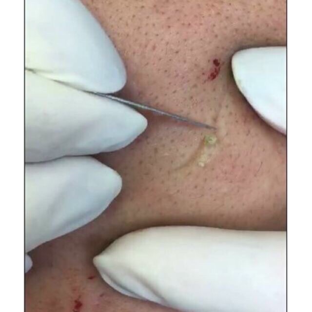 [SKIN HOUSE] 10 DAO NẶN MỤN SIÊU BÉN | BigBuy360 - bigbuy360.vn