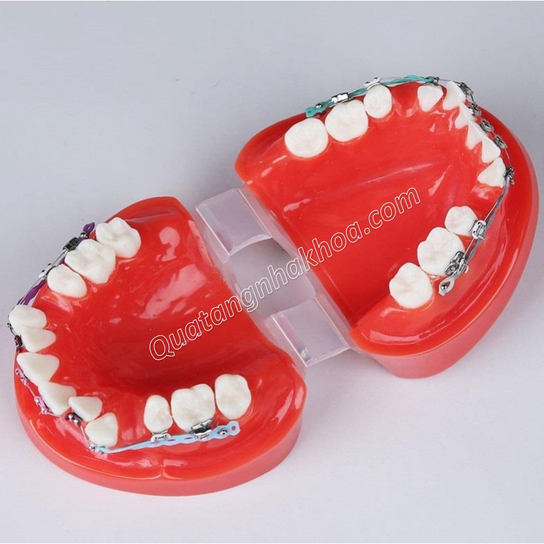 Mô hình mẫu hàm tư vấn chỉnh nha/ niềng năng đầy đủ mắc cài, dây cung, khí cụ - Mô hình răng nha khoa
