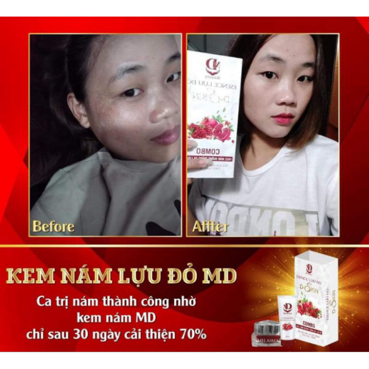 Kem Face Nám Lựu Đỏ MD, Trắng Da, Loại Bỏ Mụn Nám Tàn Nhang, Da Căng Bóng Trắng Sáng