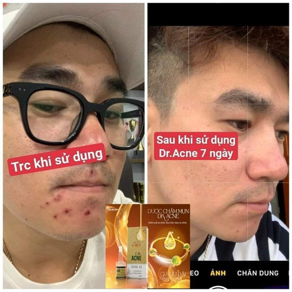 [Freeship] Dược chấm mụn dr acne Hải Âu Việt-Sạch Mụn-Không Sưng Đỏ
