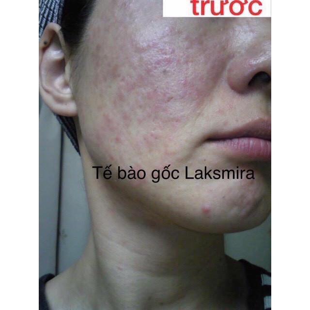 Tế bào gốc laksmira chính hãng