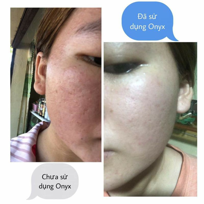 KEM DƯỠNG DÀNH CHO DA MỤN ONYX | BigBuy360 - bigbuy360.vn