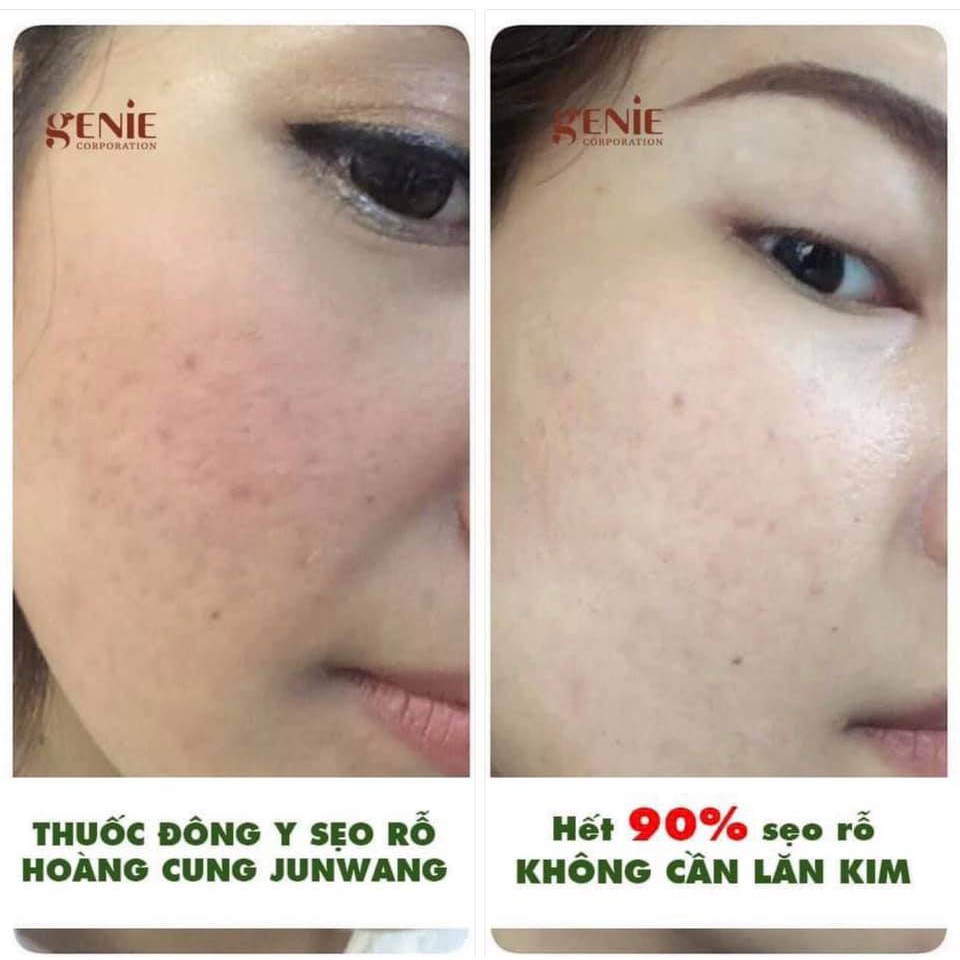 KEM ĐÔNG Y CHỮA SẸO RỔ GENIE NON MTS FIX SKIN | BigBuy360 - bigbuy360.vn