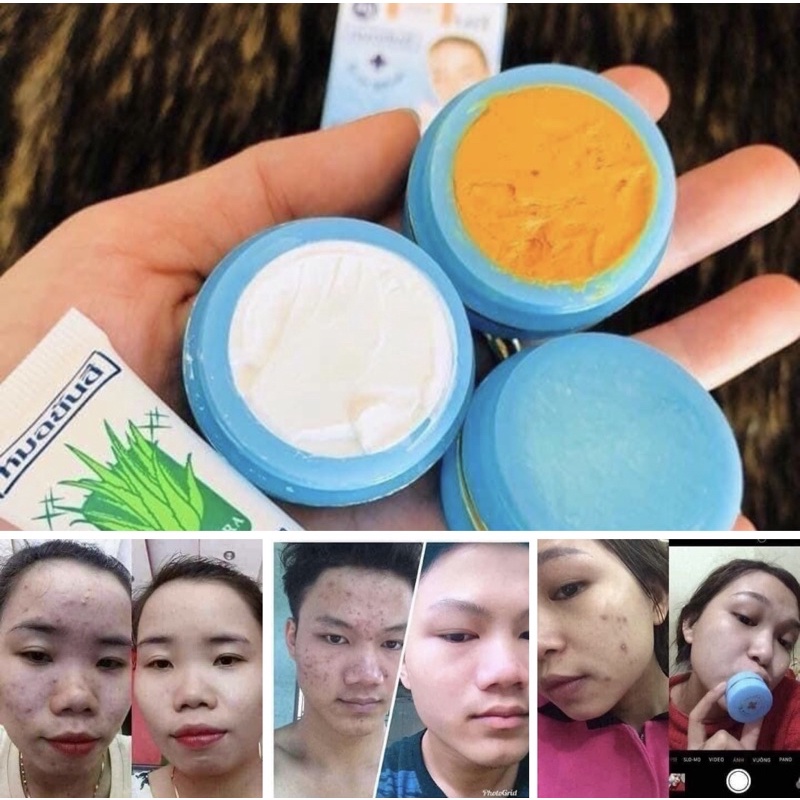 BỘ KEM MỤN,KEM THAM MỤN CHUYÊN SAU THÁI LAN