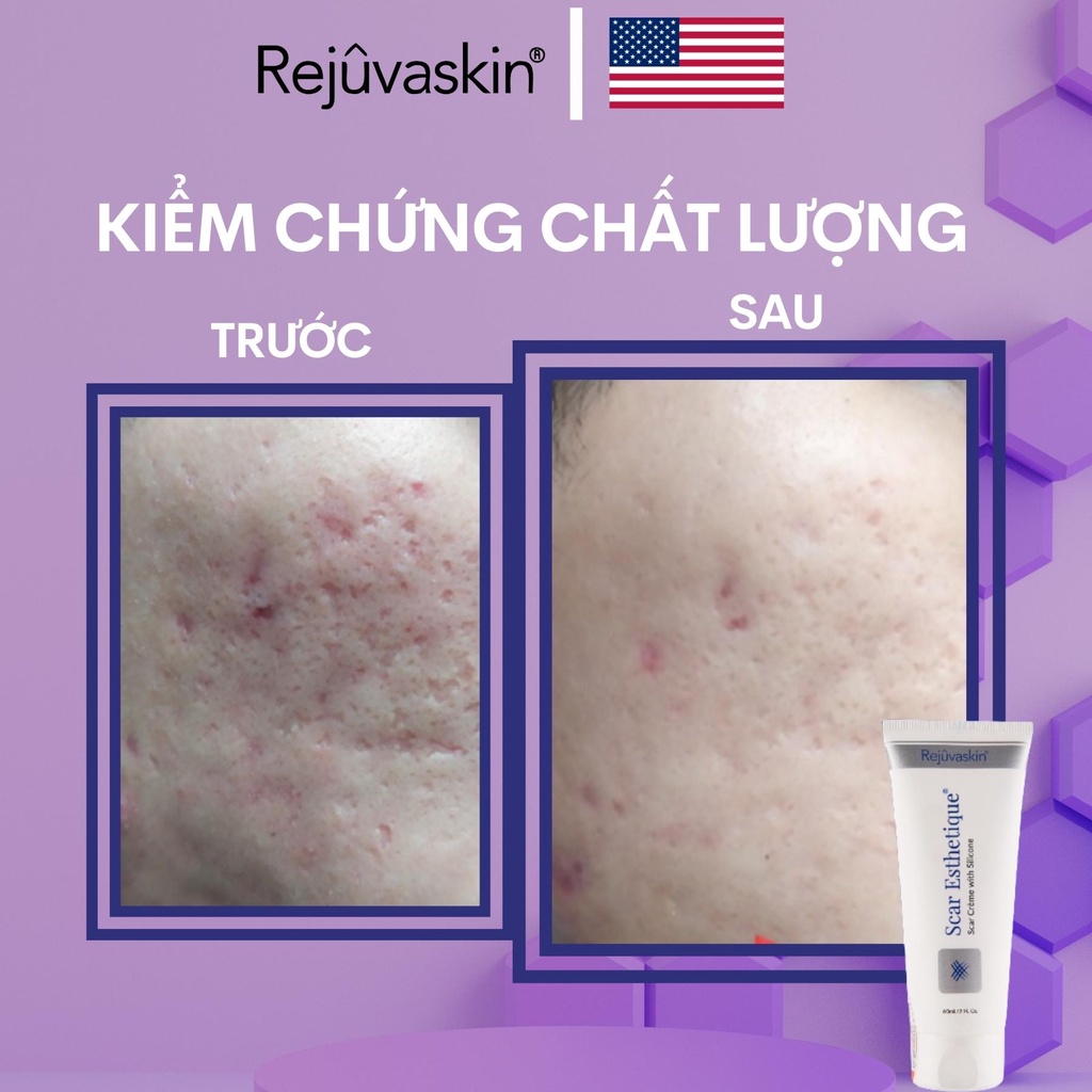 Kem hỗ trợ làm mờ sẹo rỗ, thâm, lõm xấu xí Scar Esthetique Scar Creme 4ml dùng thử