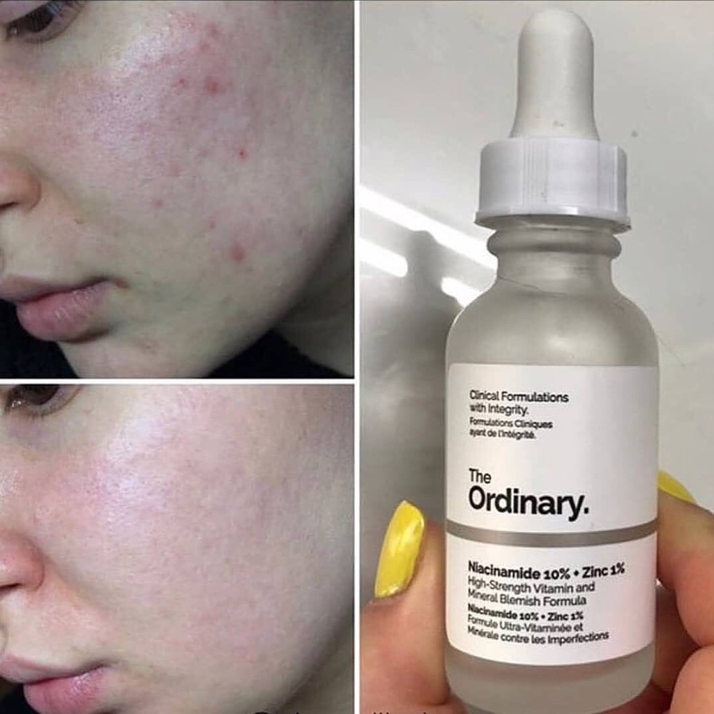 Serum The Ordinary Niacinamide 10% + Zinc 1% – Serum Chống Viêm, Giảm Kích Ứng Dành Cho Da Mụn
