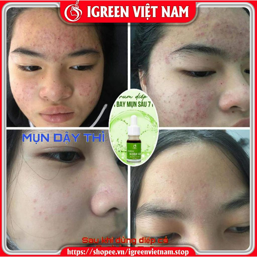 Serum Diếp Cá GIẢM MỤN, THÂM, SE KHÍT LỖ CHÂN LÔNG IGREEN - Serum Diếp Cá IGREEN