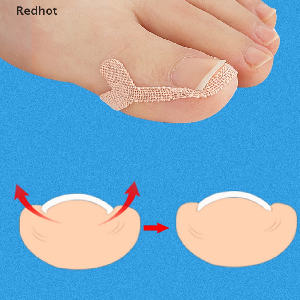 [Hàng mới về] Dụng cụ chỉnh hình móng chân hỗ trợ giảm đau