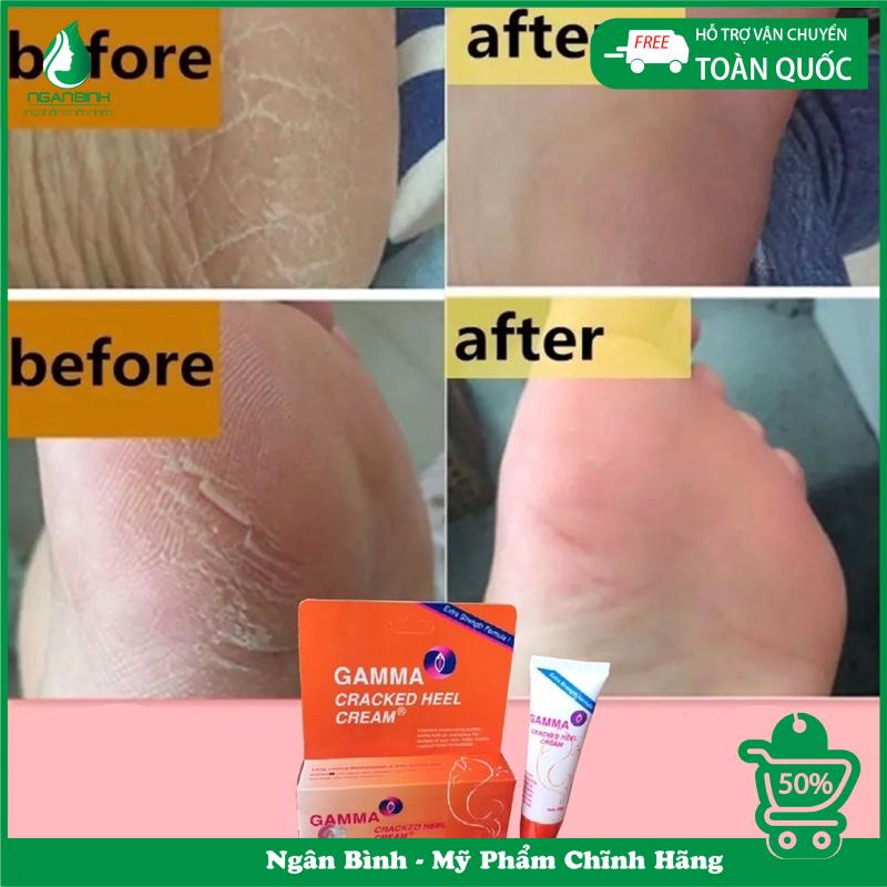 Kem giảm nứt gót chân, khô nứt da Gamma Cracked Heel sản phẩm chuyên dùng cho da khô nứt nẻ cho kết quả cực kỳ tốt. ...