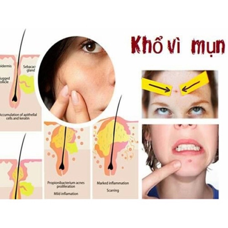 Kem mụn lưu Huỳnh Cephar 25gr - lấy sạch bã nhờn