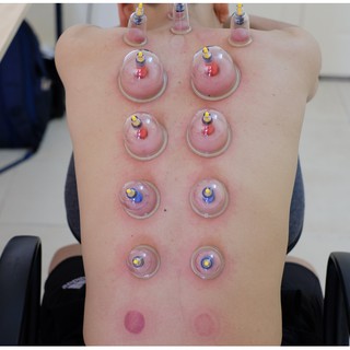 [GIÁ XƯỞNG LOẠI 1] Bộ giác hơi chân không 32 cốc không dùng lửa.