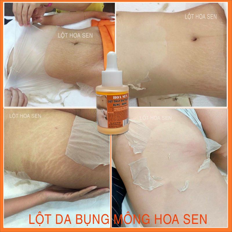 Lột Thay Da Tái Tạo Bụng Mông Bẹn Mờ Rạn Nứt Hết Thâm Sạm